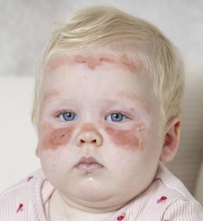 흐린 날씨에 어린이용 'SPF(자외선차단지수)50' 자외선차단제를 바른 스코틀랜드 12개월 여아 레건이 얼굴에 심한 화상을 입어 논란이 제기됐다. /사진=SNS 갈무리