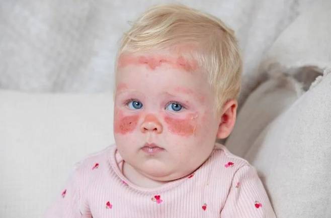 [서울=뉴시스] 영국 스코틀랜드에서 SPF 50 아동용 자외선 차단제를 바른 생후 12개월 아기가 얼굴 전체에 심각한 화상을 입어 논란이 되고 있다. (사진 = 야후뉴스 캡처) 2025.07.16. *재판매 및 DB 금지