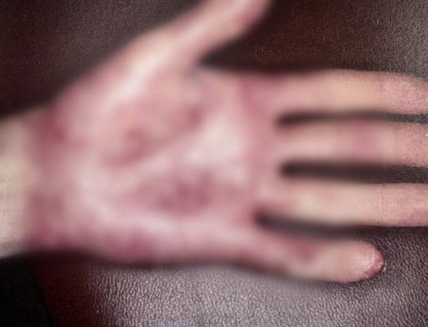 손발바닥농포증이 나타난 손 사진./사진=UpToDate