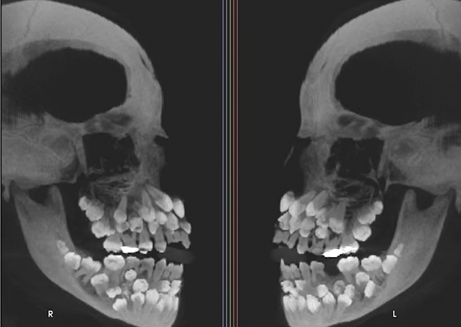 11세 소녀 입안에서 치아가 81개나 발견돼 학계가 관심을 보이고 있다. [사진 출처 = VN익스프레스]
