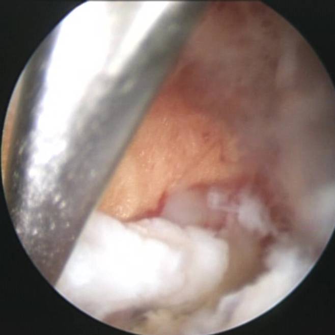 내시경으로 수핵을 제거하는 사진