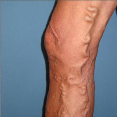 하지정맥류 [서울성모병원 제공]