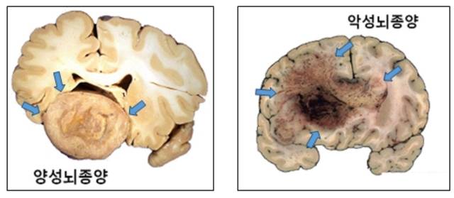 양성뇌종양과 악성뇌종양. 서울대병원 제공.