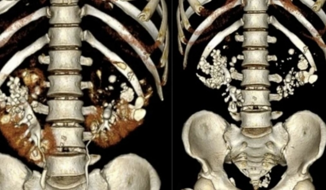 수백 개의 결석으로 가득 찬 35세 남성의 신장 CT 스캔 영상. 하노이 E병원