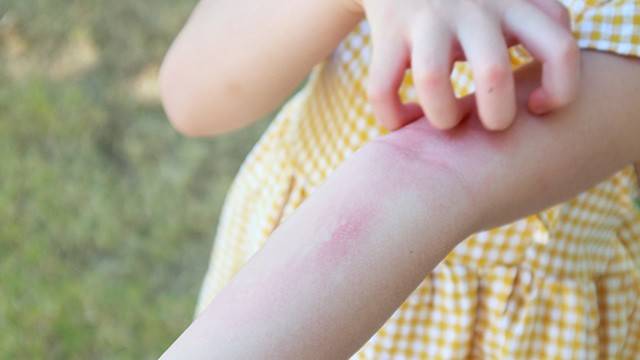 땀띠는 영유아에서 발생 위험이 높아 주의가 필요하다｜출처: 게티이미지뱅크