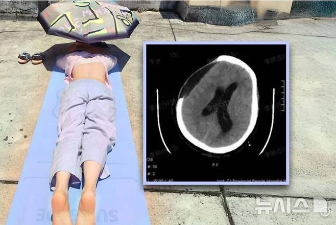 [서울=뉴시스]중국의 한 여성이 일광욕을 두 시간이나 즐기다 뇌출혈로 쓰러져 혼수상태에 빠진 것으로 전해졌다. (사진=SCMP) 2025.7.20