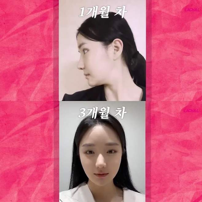 1753088575.jpg 성형 후기