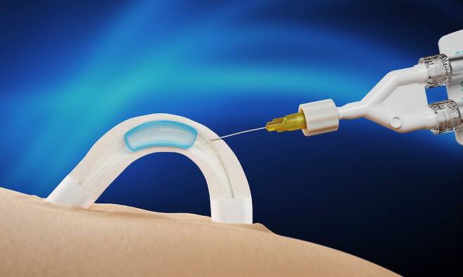 미국 바이오 기업 콘트랄린은 지난 4월 정자 이동을 막는 피임 기구 아담(adam)의 임상 1상 시험을 발표했다./Contraline