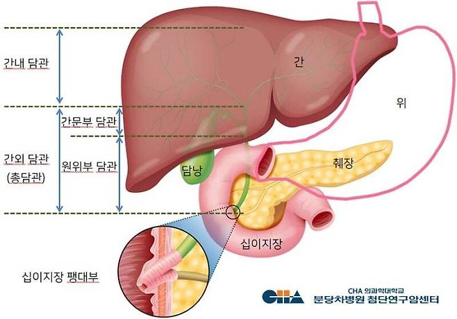 종양 발생 위치에 따른 담도암의 세부 구분. 분당차병원 제공