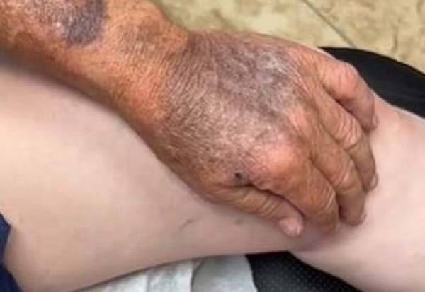 70년 동안 자외선 차단제를 바르지 않고 지낸 남성의 피부 상태가 공개된 영상이 화제다./사진=데일리메일