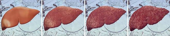 건강한 간에서 간섬유화, 간병변을 거쳐 간암으로 진행하는 모습(왼쪽부터)./대한간학회 제공