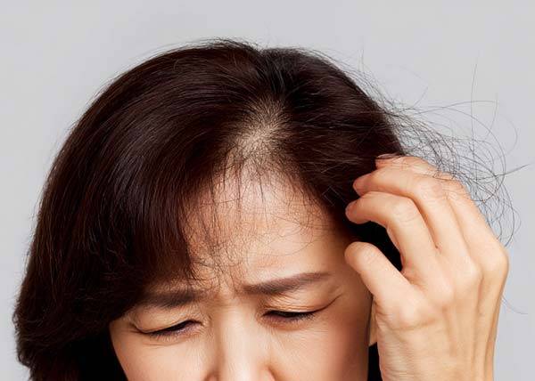 여성 탈모 환자들의 감정 영역의 손상이 두드러졌다며​ 연구 결과가 나왔다.​/사진=클립아트코리아
