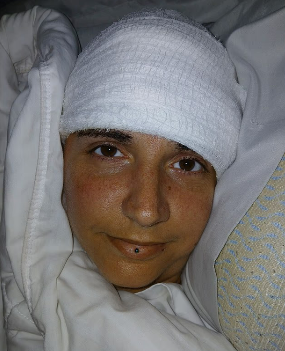 뉴럴링크 칩 이식 수술을 받은 오드리의 모습. 영국 데일리메일 캡쳐