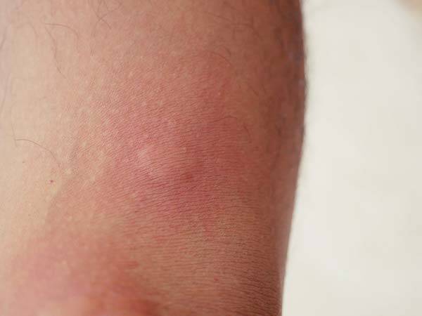 모기가 옮기는 바이러스 질환인 ‘치쿤구니야열병’이 전 세계적으로 확산하고 있다./사진=게티이미지뱅크