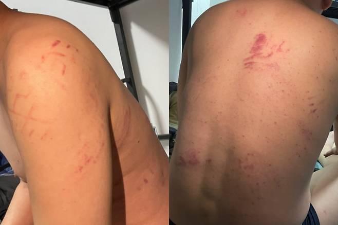 캄보디아 포이펫에 있는 한 사기 콜센터에서 한국인이 폭행을 당해 온몸에 붉은 멍 자국이 남아 있다.  /사진=독자 제공