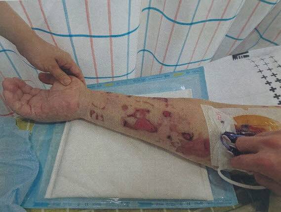 장염 환자의 팔에 생긴 피부 발진 모습.