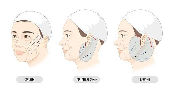 최근 '회춘' 수술로 안면거상술에 대한 관심이 커지고 있다./사진=스누성형외과 제공