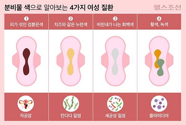 검붉은색 분비물은 자궁암을, 누런색 분비물은 칸디다 질염을, 회백색 분비물은 세균성 질염을, 황색·녹색 분비물은 클라미디아 감염​울 의심해야 한다./그래픽=김민선