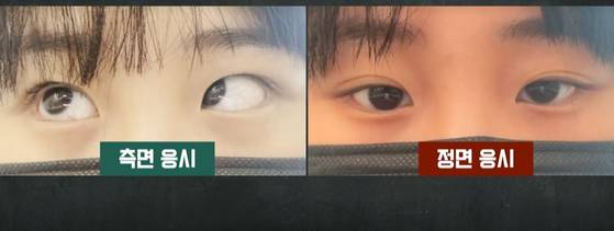 A woman who received under eye fat removal surgery at a clinic in Daegu in February said she suffered from double vision and eye misalignment in an appearance on JTBC's "Crime Chief" (2014-) on Aug. 4. [SCREEN CAPTURE]