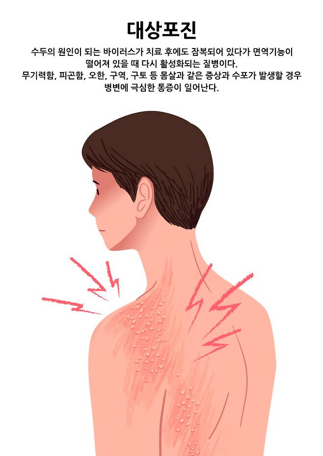 대상포진. /게티이미지뱅크