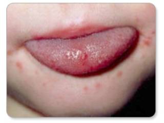 수족구병에 감염된 어린이의 혀와 입 주위 발진. /사진=질병관리청 국가건강정보포털