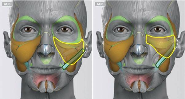 광대근(초록색)이 낮게 위치하며 근육에 붙어있는 볼살(노란색)도 함께 아래로 떨어진 상태인 왼쪽. 오른쪽은 근육과 볼살이 함께 위쪽에 위치한 이상적인 상태. 볼처짐의 개선 목표는 근육과 볼살이 함께 위쪽으로 올라간 상태가 되어야 한다.