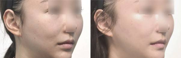 광대수술 후 발생한 볼처짐을 골막하 거상으로 개선한 모습.