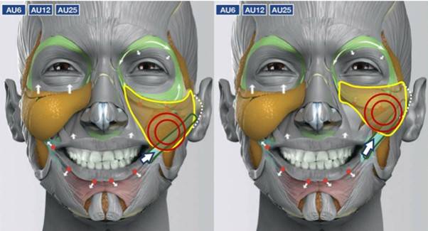 광대근과 볼살이 낮으면 웃을 때 입꼬리는 옆쪽으로 향하고, 아래쪽 볼 부위가 돌출됨(왼쪽). 광대근과 볼살이 높으면 웃을 때 입꼬리는 위쪽으로 향하고, 눈 아래 볼륨이 채워진다(오른쪽). [그림=Anatomy of Facial Expression]