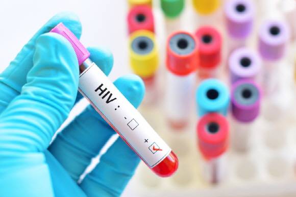 HIV 테스트. [사진=게티이미지뱅크]