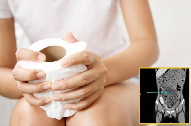 복통과 복부팽만감을 증상으로 응급실을 찾은 여성의 뱃속에서 수개월간 쌓인 변이 확인된 사례가 보고됐다. [배경사진=게티이미지뱅크/오른쪽 하단 사진='Cureus']