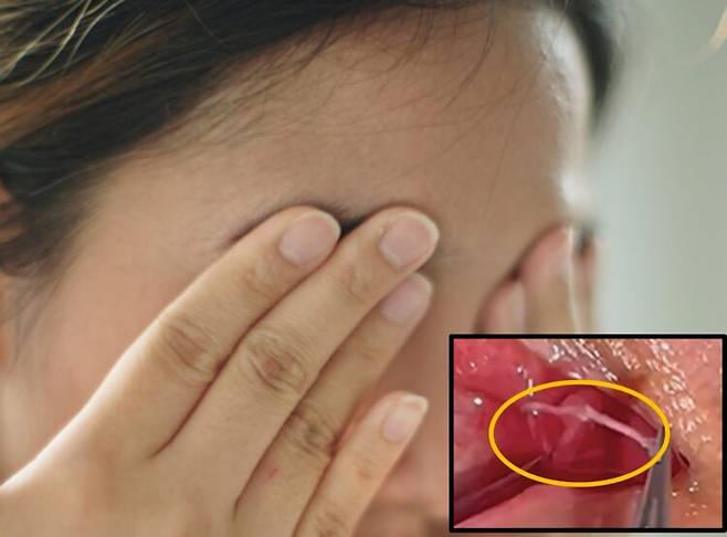 한 여성이 눈에 이물감이 계속 생겨 병원을 찾은 끝에 기생충 4마리가 기어 다니고 있었다는 사례가 보고됐다. [배경 사진=게티이미지뱅크/ 하단 기생충 =BMC Ophthalmology]