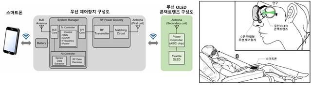 무선 OLED 콘택트렌즈를 활용한 망막전위도 검사 시스템의 모식도와 실제 검사 모습의 예시. /사진제공=분당서울대병원