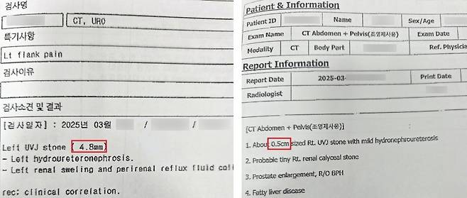 급여 삭감된 요로결석 환자들의 결석 크기 판독 기록 (전주=연합뉴스) 왼쪽 환자의 결석 크기는 일반적인 쇄석술 급여 지급 기준(4㎜)을 넘는 4.8㎜, 오른쪽 환자는 5㎜로 측정됐다. 이들 환자는 신원 정보를 공개하지 않는 조건으로 진료기록의 보도 활용에 동의했다. [재판매 및 DB 금지]