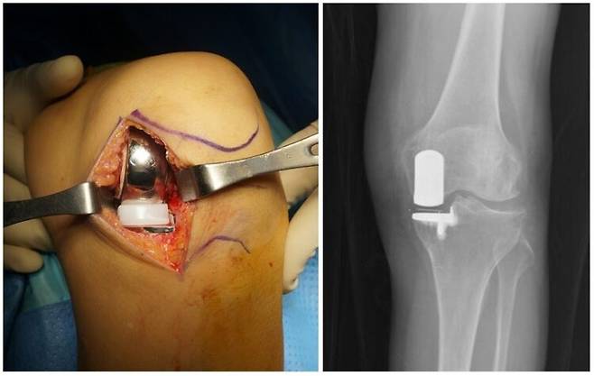 '부분치환술' 술 중 사진 & 술 후 X-ray.
