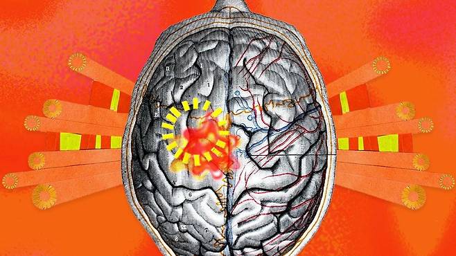 붉은색으로 이상 부위가 표시된 두뇌