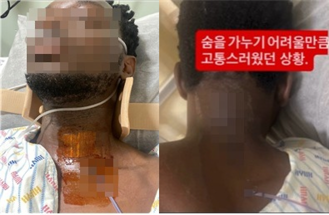 수술 직후 치료를 받고 있는 피해자 모습. 목 부위에는 큰 수술 자국이 남아 있다. [사진출처=온라인 커뮤니티]