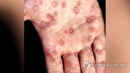 매독 [연합뉴스]