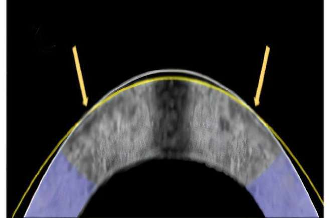 전기기계적 재형성 기술은 단면에 표시된 토끼 각막을 원래 모양(흰색 선)에서 교정된 모양(노란색 선)으로 성공적으로 평평하게 만들었다.