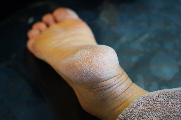 각질 낀 딱딱한 발뒤꿈치는 전염성이 강한 무좀 신호일 수 있다​./사진=클립아트코리아