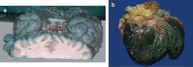 메틸렌 블루로 장기가 청록색으로 물든 모습. 뇌의 단면과 심장. 사진=Baumgarten/Forensic Science, Medicine and Pathology