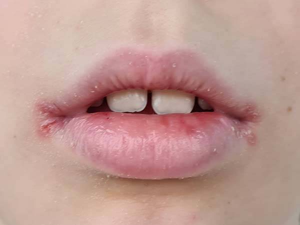입술은​ 피부가 얇고 피지선이 없어 쉽게 손상되므로 작은 변화에도 주의를 기울여야 할 부위다./사진=게티이미지뱅크