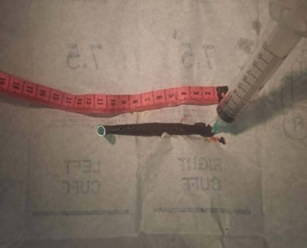 5세 소녀의 목 구멍에서 발견된 11cm 길이의 거머리./사진=국제외과사례보고저널