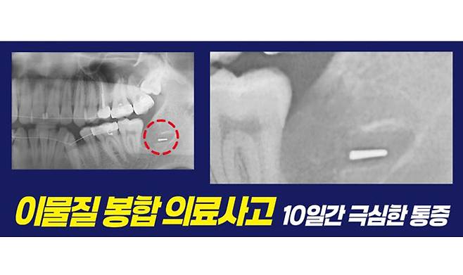 성남시의 B치과에서 A씨가 치아 교정 치료를 위해 발치한 이후 이물질이 발견된 X-ray 사진 <A씨 가족 제공>