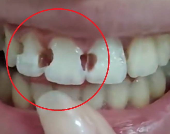 5년간 치아 교정 치료를 받아 온 중국의 한 20세 여성이 구강 위생 관리가 제대로 이뤄지지 않아 치아 8개에 구멍이 뚫린 사연이 알려져 충격을 주고 있다. 웨이보