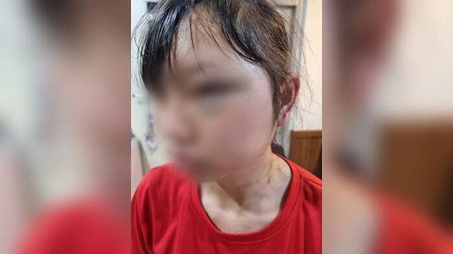 폭행 피해 당한 여성 이주노동자 B씨/연합뉴스