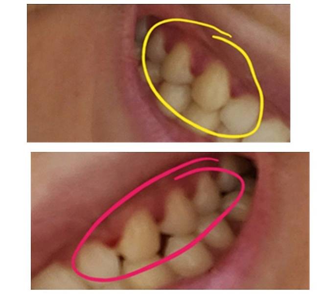 셀프 치아 장치 사용 후 치은 부종이 생긴 사례.