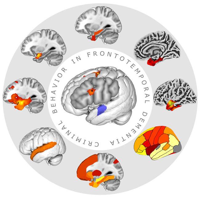 치매 환자의 범죄 행동 관련 뇌 이미지. MPI CBS 제공.