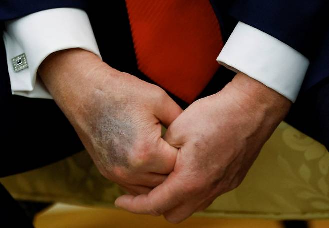 25일(현지시간) 미국 워싱턴DC 백악관 집무실에서 이재명 대통령과 회담하는 동안 도널드 트럼프 미국 대통령의 멍든 오른 손이 보인다. 2025.8.25 /로이터=뉴스1