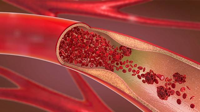 혈관 건강이 나빠지면 고혈압, 심근경색, 뇌졸중 등 심각한 질환으로 이어질 수 있다|출처: 클립아트코리아