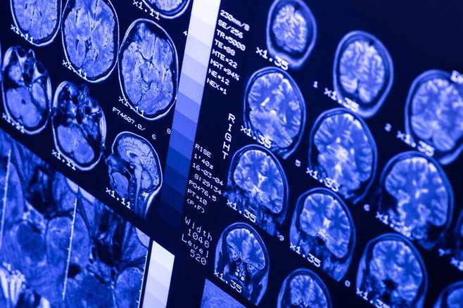MRI로 촬영한 뇌 영상. [사진=게티이미지뱅크]